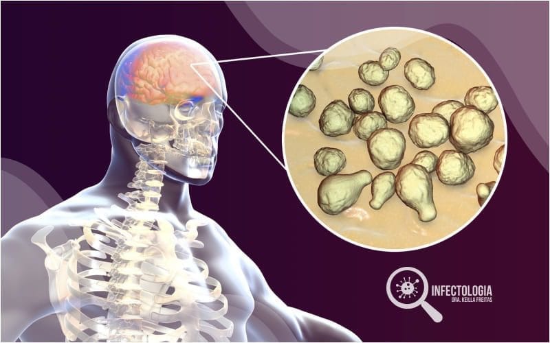 Meningite Fúngica